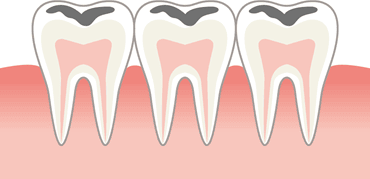 歯の噛む面の溝
