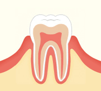 進行段階 C0　ごく初期のむし歯