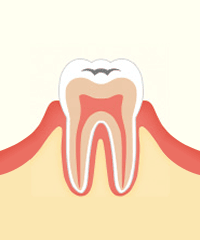 進行段階 C1　エナメル質のむし歯