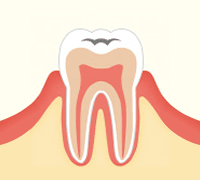 進行段階 C1　エナメル質のむし歯
