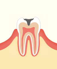進行段階 C2　象牙質のむし歯