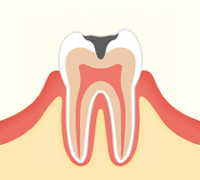 進行段階 C2　象牙質のむし歯