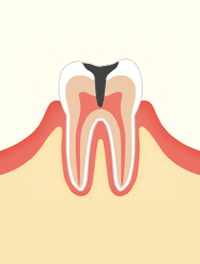 進行段階 C3　神経まで達したむし歯