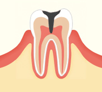 進行段階 C3　神経まで達したむし歯