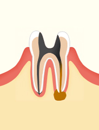 進行段階 C4　根まで達したむし歯