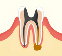 進行段階 C4　根まで達したむし歯