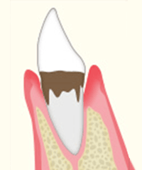 進行段階3　中等度の歯周病