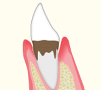 進行段階3　中等度の歯周病